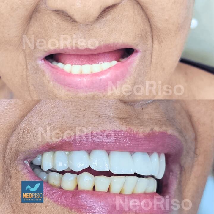 O que é Uma Prótese Dentária NeoRiso Ondotologia