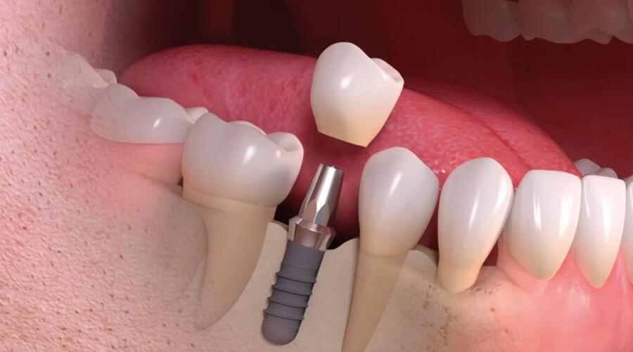 Procedimento de colocação de implante dentário na NeoRiso.
