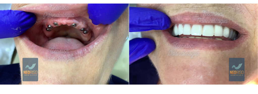 Procedimento de colocação de implante dentário na NeoRiso Antes e Depois
